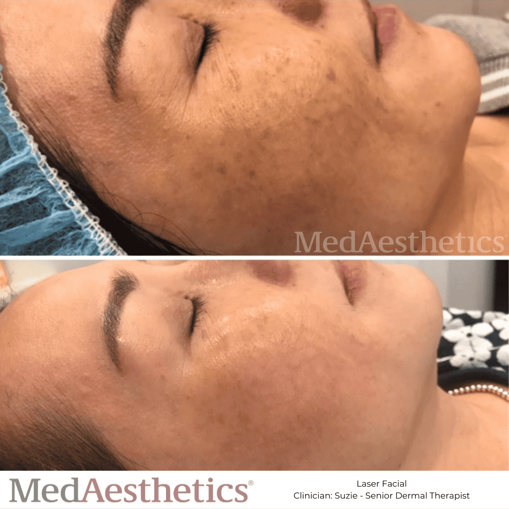 Laser Facial Revlite Skin Rejuvenation Perth Medaesthetics