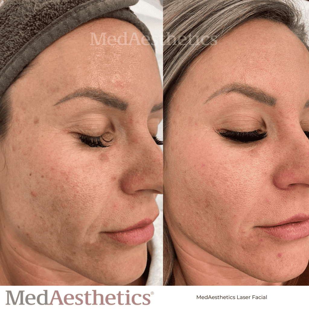 Laser Facial Revlite Skin Rejuvenation Perth Medaesthetics